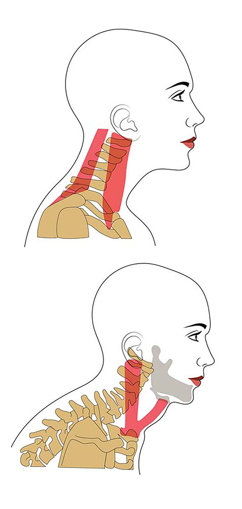 Graphical representation of neck muscle Sternocleidomastoid